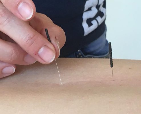 En klient modtager en Akupunktur behandling hos Aku-Fysio Klinik