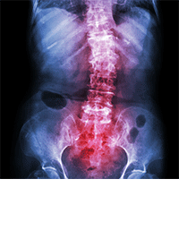 Viser et røntgen-billede af en skæv rygsølje, også kaldet skoliose, som behandles hos Aku-Fysio Klinik.