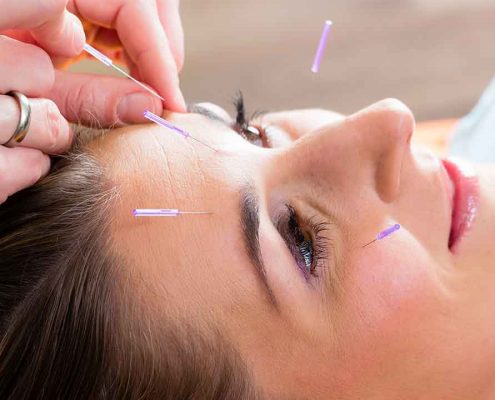 En klient modtager Kosmetisk Akupunktur hos Aku-Fysio Klinik